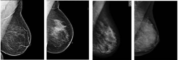 Limitation of screening mammography: Overall sensitivity 75% varies depending...