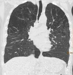 Coronal MPR of a patient with advanced
emphysema