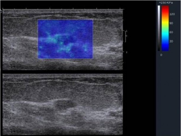 Top: ShearWave Elastography.: E max 180 kPa. Colour scale from blue to red...