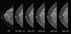 Breast Tomosynthesis