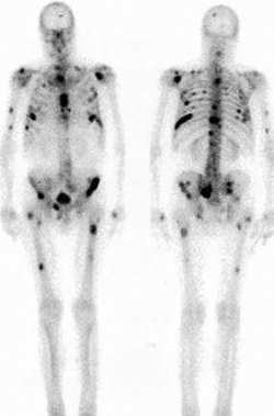 Radionuclide Bone Imaging