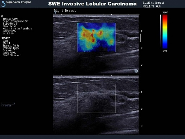 Photo: Proven Benefits of ShearWave Elastography