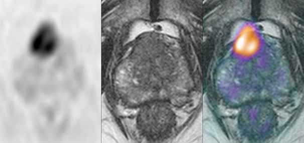 Diffusionsgewichtete MRT-Aufnahme: Klare Detektion eines Tumors in der...