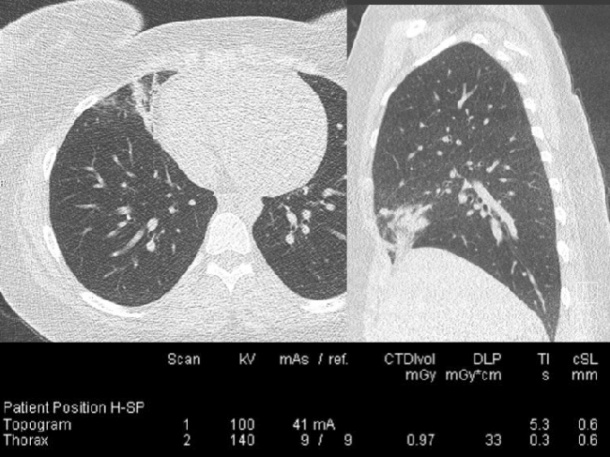 Low-dose chest CT delivering 33 mGy.cm (0.5 mSv) in a female patient (90 kg)...
