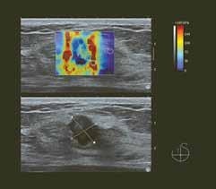 Photo: Study proves benefits of ShearWave Elastography