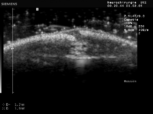 Ultraschallbild von einer offenen Schädelnaht. Gut zu sehen ist die knöcherne...