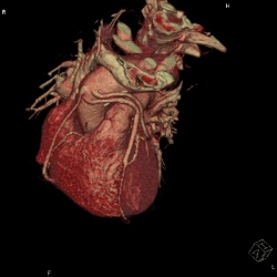 Photo: CT angiography best for low-risk patients