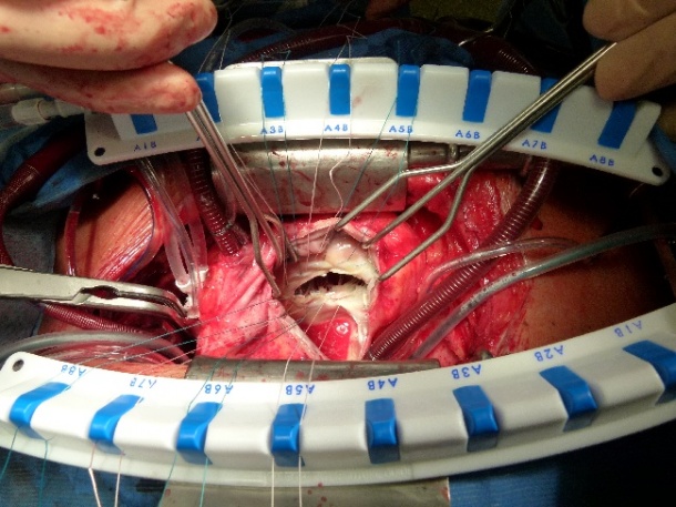 Aortic Valve Replacement Surgery