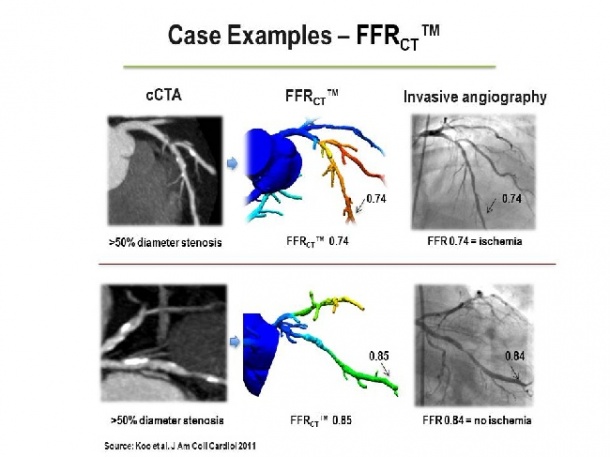 Two case examples of patients with >50% coronary artery stenosis on cCTa but in...