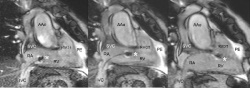 MRI post inferior isthums ablation: the catheter tip, much of the shaft and...