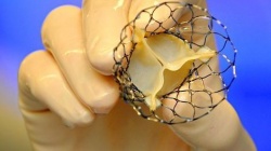 Photo: Frauen profitieren von Aortenklappen-Implantation mehr als Männer