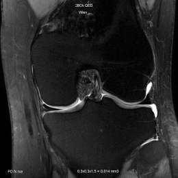 High-res image of knee joint with 7-Tesla
