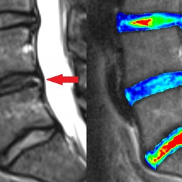 Anatomical and biochemical imaging (in colour) of worn out lumbar disc