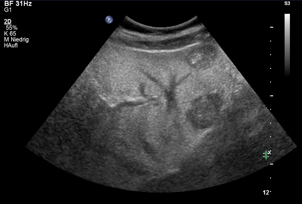 liver-lesions-are-most-often-benign-healthcare-in-europe