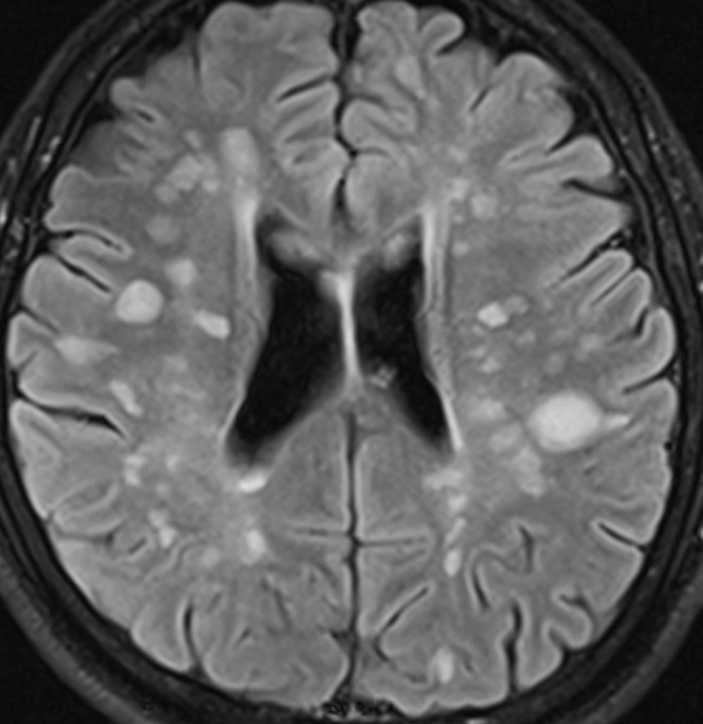 Das Ruckenmark Als Schlussel Zur Ms Diagnostik