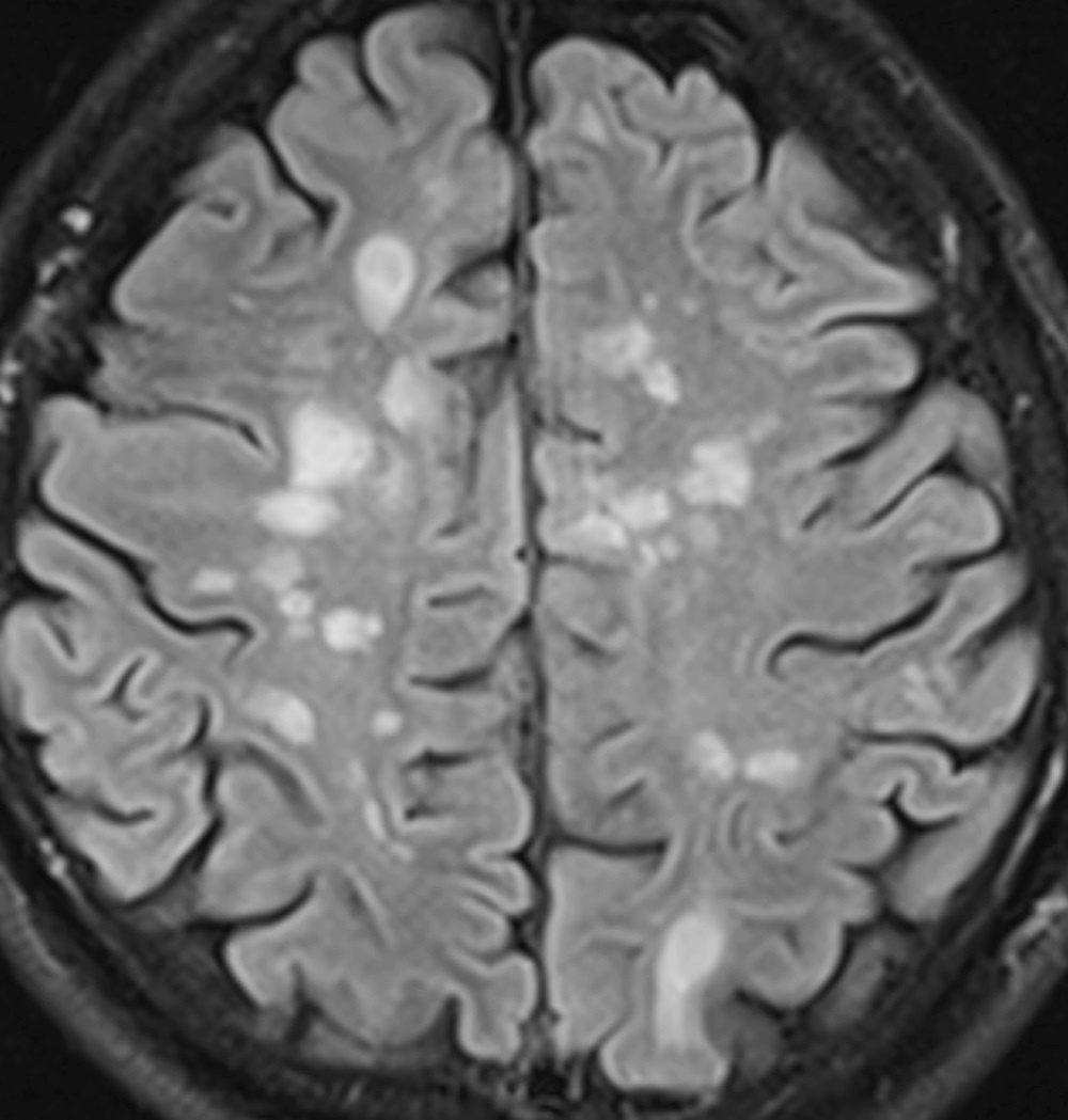 Das Ruckenmark Als Schlussel Zur Ms Diagnostik