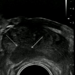 B-Bild-Ultraschall stellt das Karzinom echoarm dar (Pfeile)