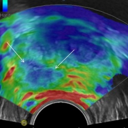 Ultraschallelastographie stellt das Karzinom hart (blau, Pfeile) dar