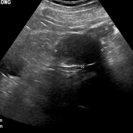 Ultrasound of the right kidney in a 65 year-old male demonstrates a solid...