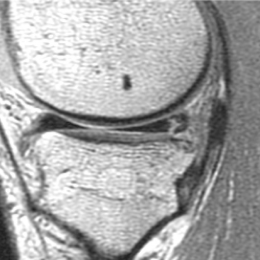 2a. Sagittal MRI image shows a peripheral medial meniscal tear. This subtle...