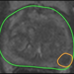 Step 1: Areas of suspicious tissue are identified and contoured on MRI scans.