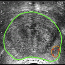 3: The model is mapped onto ultrasound imaging in real-time.