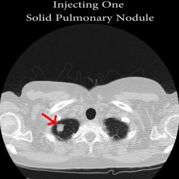 This process works both ways: In this scan, a solid pulmonary nodule was added,...