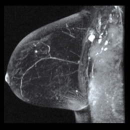 Maximum-Intensitäts-Projektion zeigt den kleinen Tumor
