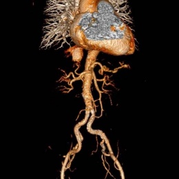 Illustration of added value of lower keV reconstructed images when the vascular...