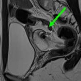 [T2 TSE sagittal] Left adnexal torsion due to a benign para tubal cyst:...