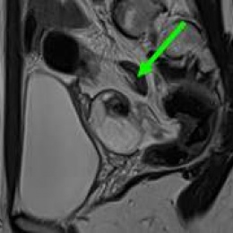 [T2 TSE sagittal] Left adnexal torsion due to a benign para tubal cyst:...