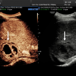 The CEUS image (left) shows a partially liquefied abscess (arrow), which is...