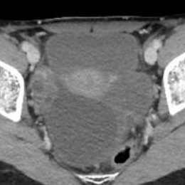 [CT] Left adnexal torsion due to a benign para tubal cyst: enlarged edematous...