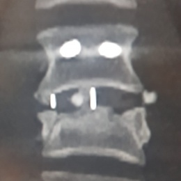 A computed tomography (CT) scan of the lumbar spine, image of face at 30 days...