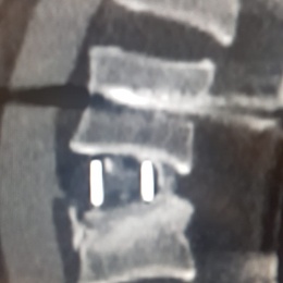 A computed tomography (CT) scan of the lumbar spine, image of profile at 30...