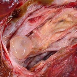 Abb. 2c: Eröffnetes Resektat mit Abbildung der großen Gallenwegs-zyste, in...
