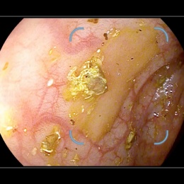 Serrated polyp in less-than-ideal bowel prep