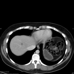 Kleine Metastase eines Kolonkarzinoms in der CT, coronar...