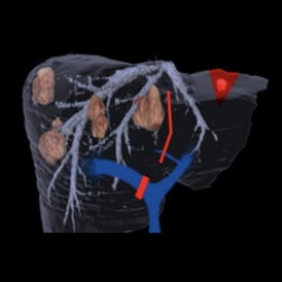 Photo: Leberbildgebung – was der Chirurg vom Radiologen braucht