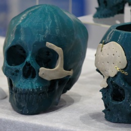 Customised bone implants made with 3D printing