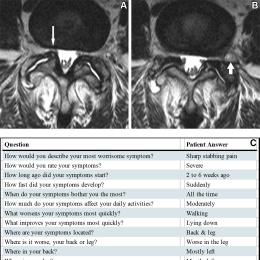 (A, B) Axial T2-weighted fast spin-echo MRI scans in a 53-year-old female...