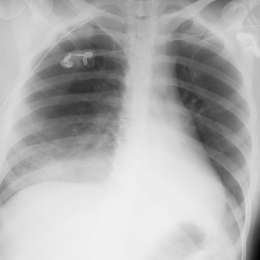 Patient 21j, männlich, z. n. Verkehrsunfall.
Links: Das Herz ist...
