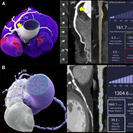 A, A 55-year-old woman with atypical chest pain and 2 cardiovascular risk...