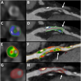 Semi-automated plaque segmentation by commercially available...