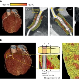 Perivascular FAI analysis around epicardial coronary vessels
(A) Perivascular...