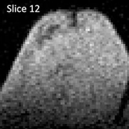 Observation of post-surgical changes on a 3D ultra-low field breast MRI scan of...