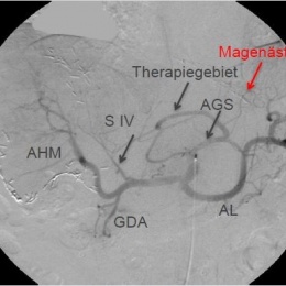 Planungsangiographie mit Tc99m MAA: Angiographie.