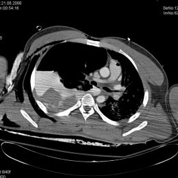 Polytrauma CT: root of the lung completely severed, right, massive...