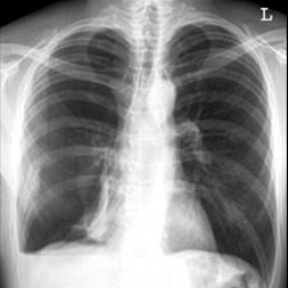 Aortic rupture with haemothorax. CT: thorax with traumatic aortic rupture in...