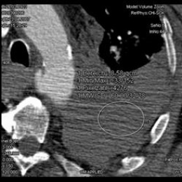 Aortic rupture with haemothorax. CT: thorax with traumatic aortic rupture in...